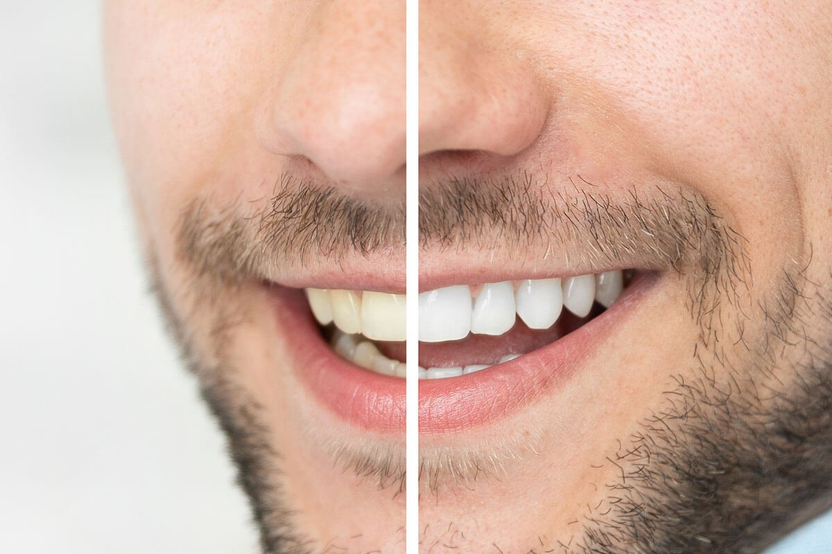 The Truth About Teeth Whitening: What You Should Know Before Getting Your Smile Brightened